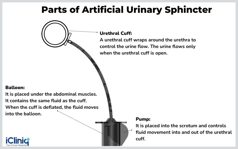 parts-of-artificial-urinary-sphincter parts-of-artificial-urinary-sphincter