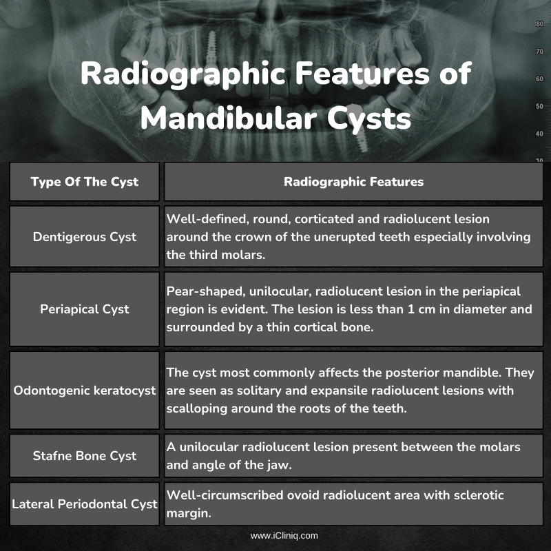 Radiographic Features of Mandibular Cysts