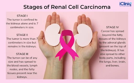 Different Stages of Renal Cell Carcinoma Different Stages of Renal Cell Carcinoma