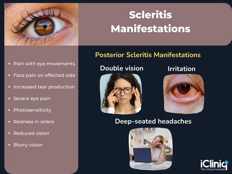 Scleritis manifestations