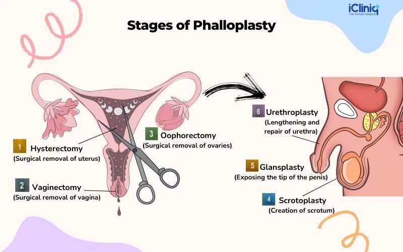 stages-of-phalloplasty