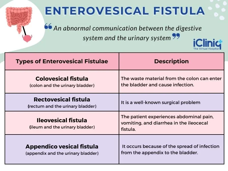 types-of-enterovesical-fistula types-of-enterovesical-fistula