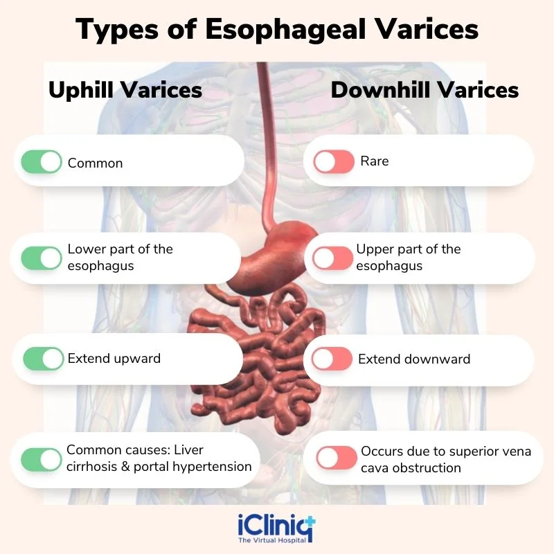 Types of Esophageal Varices Types of Esophageal Varices