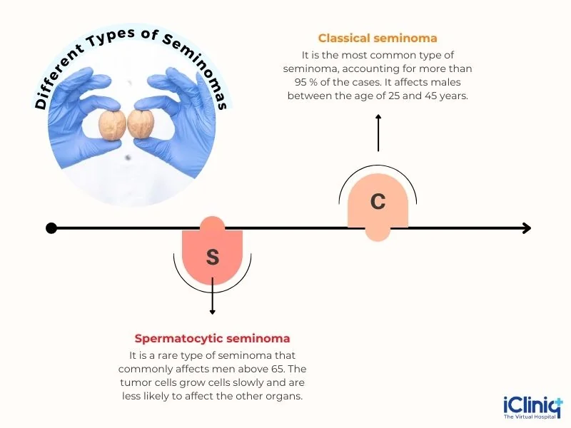 Different Types of Seminomas