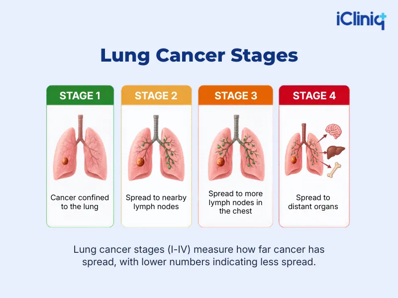 lung cancer stages