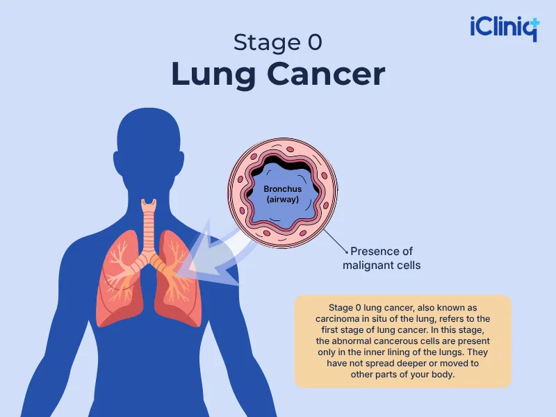 stage 0 lung cancer