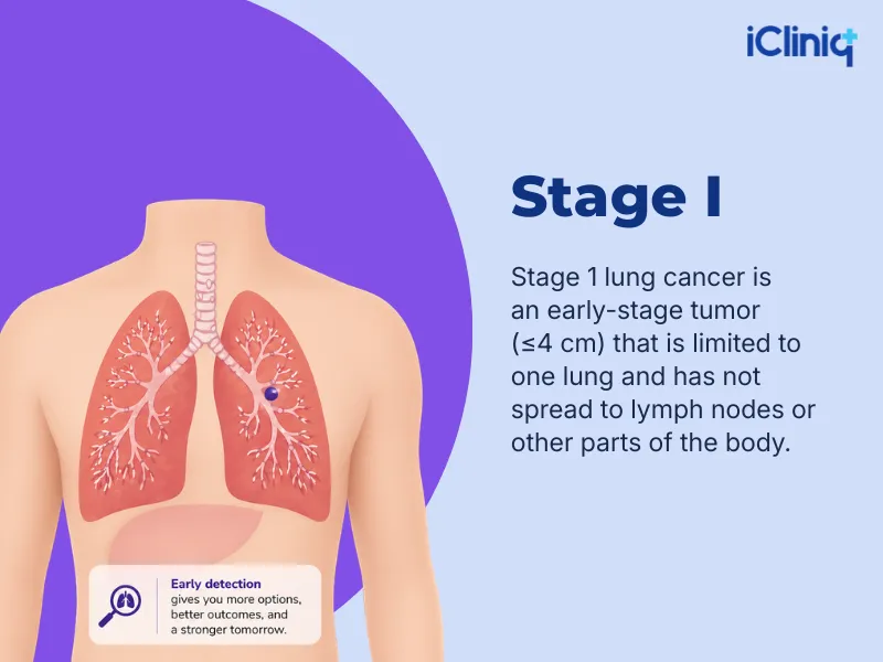 stage 1 lung cancer
