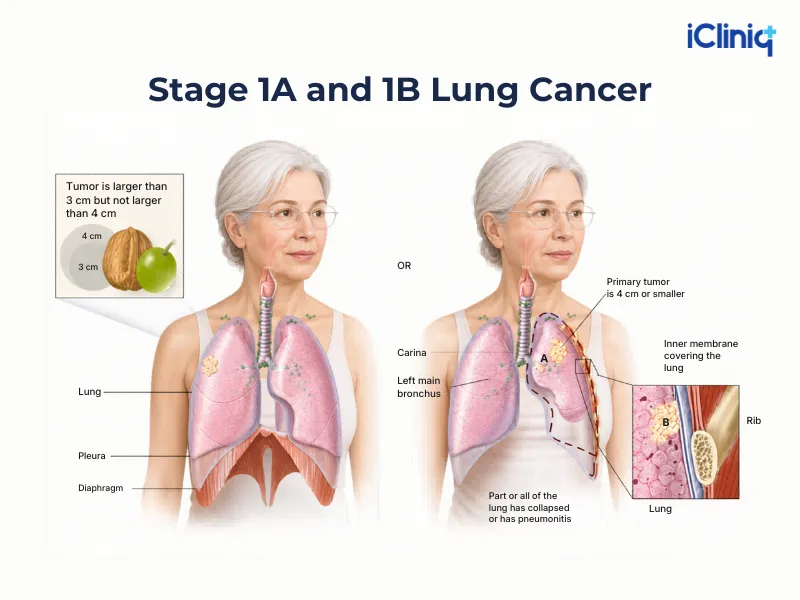 stage 1A and 1b lung cancer