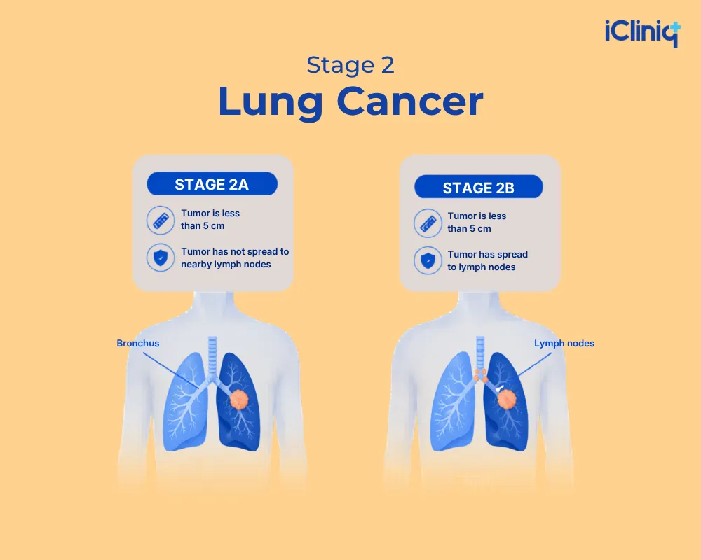 stage 2 lung cancer