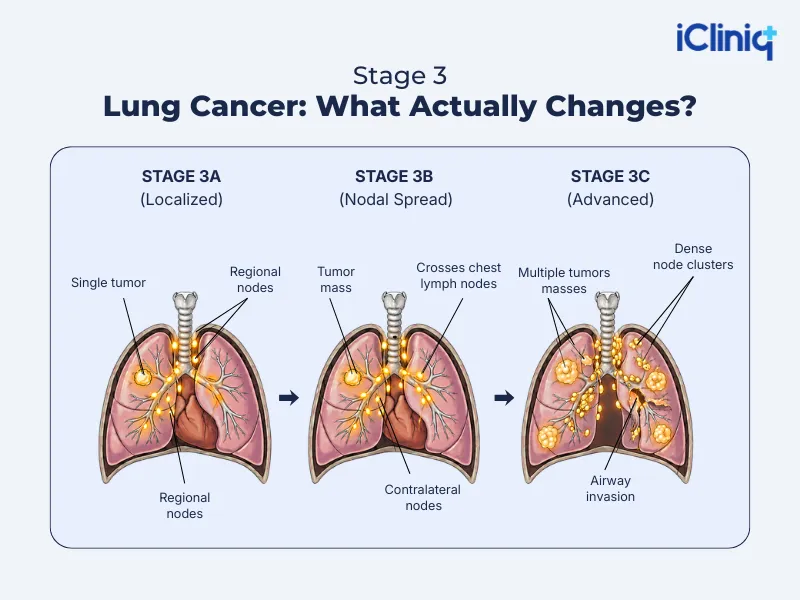 stage 3 lung cancer