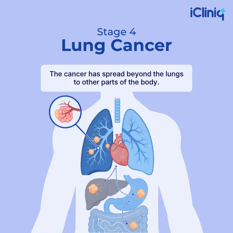 stage 4 lung cancer