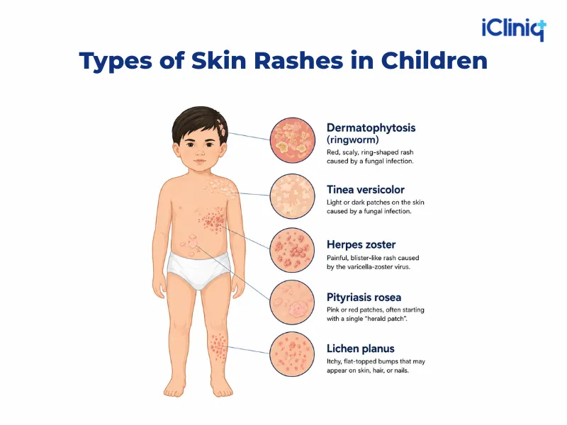 https://img.icliniq.com/types-of-skin-rashes-in-children.webp