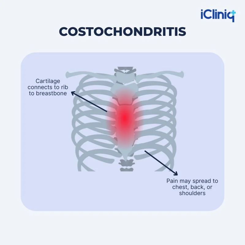 Costochondritis is inflammation of the cartilage connecting the rib to the breastbone (sternum)